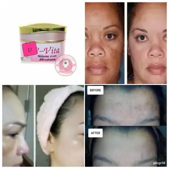 best moisturizer for melasma