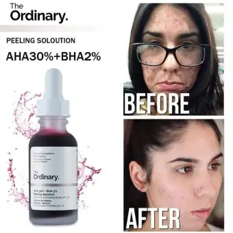 the ordinary aha bha acne scars